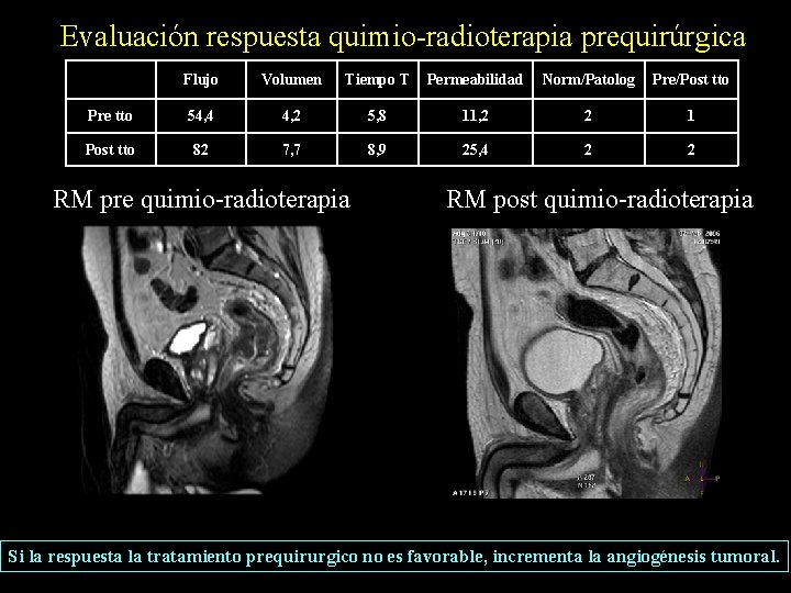  Evaluación respuesta quimio-radioterapia prequirúrgica Flujo Volumen Tiempo T Permeabilidad Norm/Patolog Pre/Post tto Pre