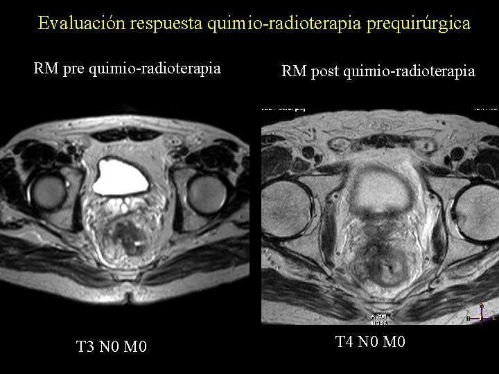 Evaluación respuesta quimio-radioterapia prequirúrgica RM pre quimio-radioterapia T 3 N 0 M 0 RM