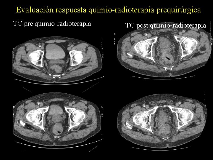 Evaluación respuesta quimio-radioterapia prequirúrgica TC pre quimio-radioterapia TC post quimio-radioterapia 