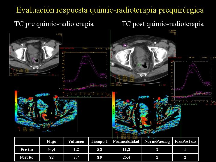 Evaluación respuesta quimio-radioterapia prequirúrgica TC pre quimio-radioterapia TC post quimio-radioterapia Flujo Volumen Tiempo T