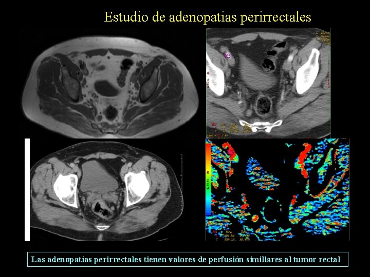 Estudio de adenopatias perirrectales Las adenopatías perirrectales tienen valores de perfusión simillares al tumor