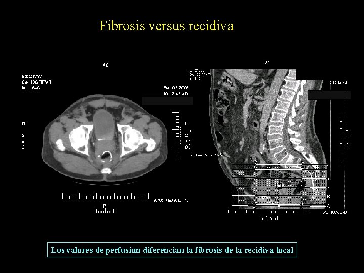 Fibrosis versus recidiva Los valores de perfusion diferencian la fibrosis de la recidiva local