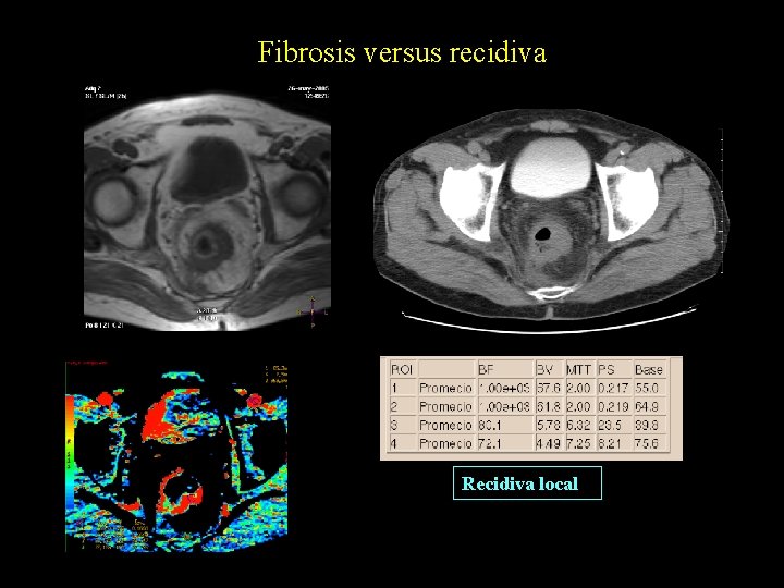 Fibrosis versus recidiva Recidiva local 