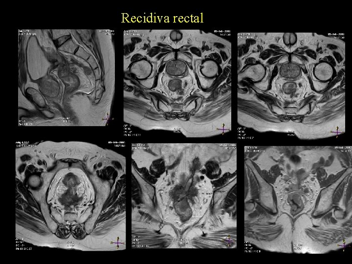 Recidiva rectal 