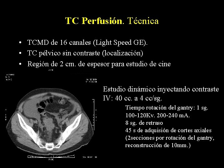 TC Perfusión. Técnica • TCMD de 16 canales (Light Speed GE). • TC pélvico