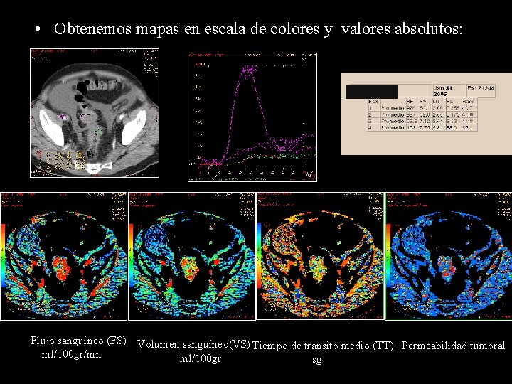  • Obtenemos mapas en escala de colores y valores absolutos: Flujo sanguíneo (FS)