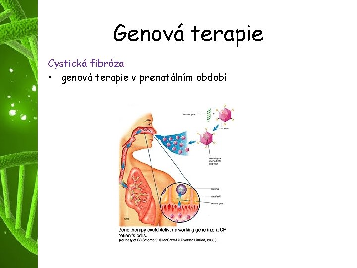 Genová terapie Cystická fibróza • genová terapie v prenatálním období 