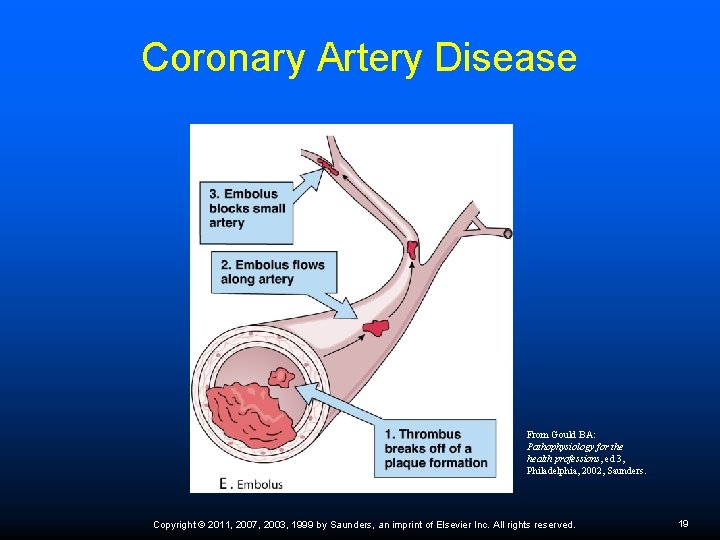 Coronary Artery Disease From Gould BA: Pathophysiology for the health professions, ed 3, Philadelphia,