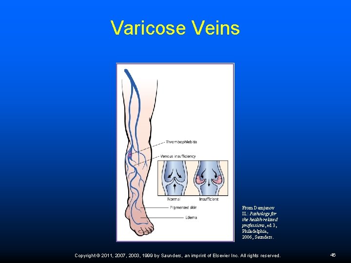 Varicose Veins From Damjanov IL: Pathology for the health-related professions, ed 3, Philadelphia, 2006,