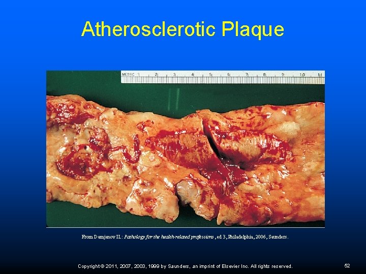 Atherosclerotic Plaque From Damjanov IL: Pathology for the health-related professions, ed 3, Philadelphia, 2006,