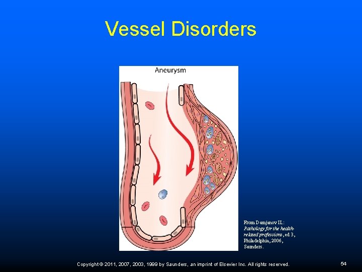 Vessel Disorders From Damjanov IL: Pathology for the healthrelated professions, ed 3, Philadelphia, 2006,