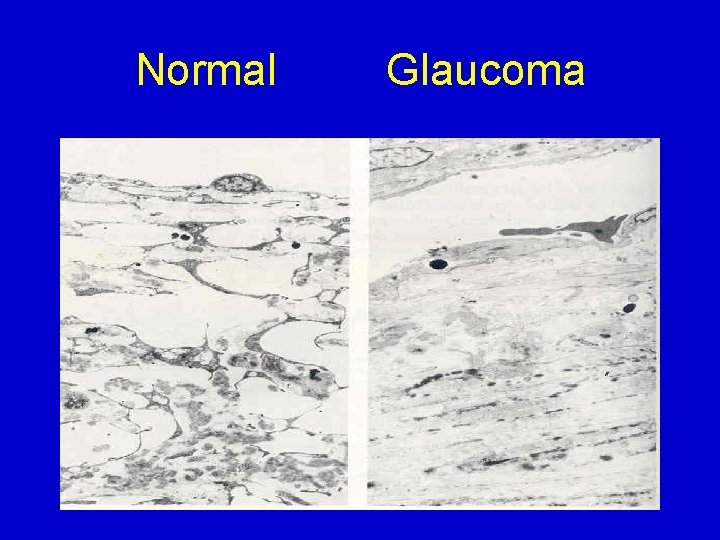 Normal Glaucoma 