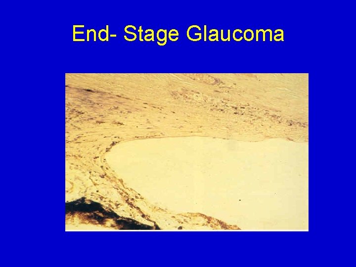 End- Stage Glaucoma 