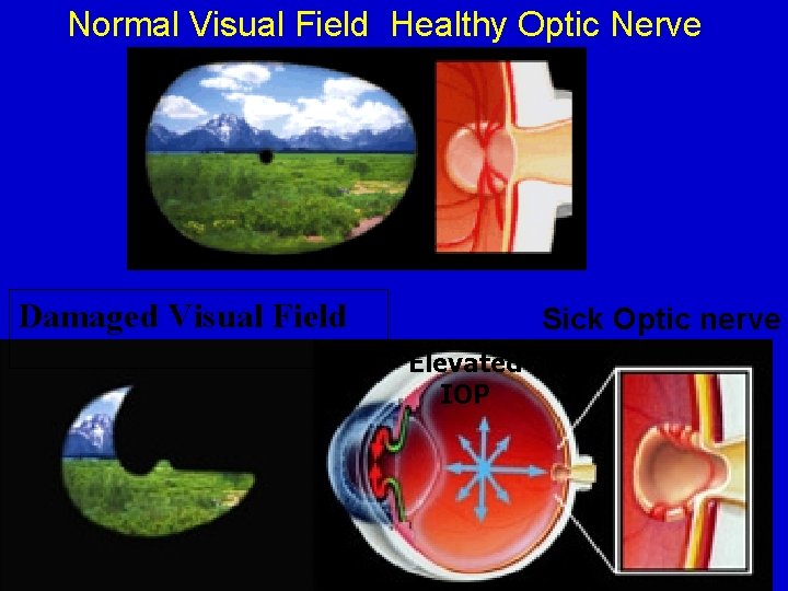 Normal Visual Field Healthy Optic Nerve Damaged Visual Field Sick Optic nerve Elevated IOP