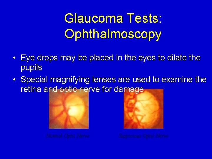 Glaucoma Tests: Ophthalmoscopy • Eye drops may be placed in the eyes to dilate