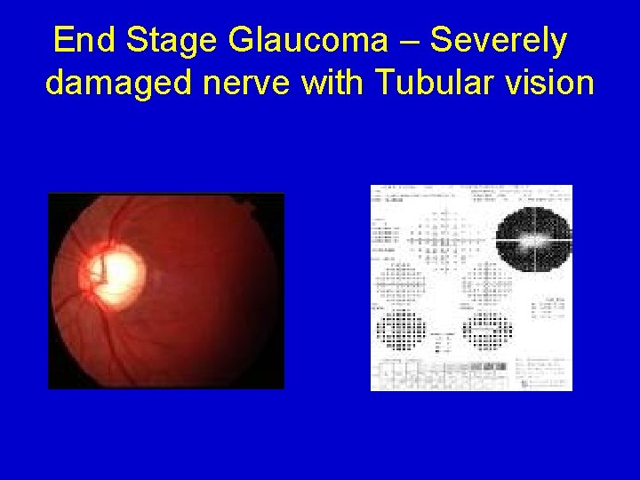 End Stage Glaucoma – Severely damaged nerve with Tubular vision 