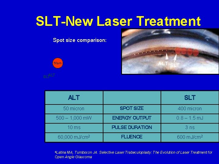 SLT-New Laser Treatment Spot size comparison: ALT SLT 50µm SLTALT SLT 50 micron SPOT