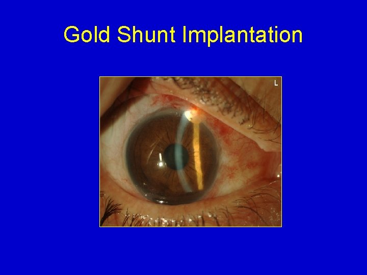 Gold Shunt Implantation 