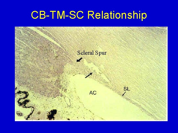 CB-TM-SC Relationship Scleral Spur 