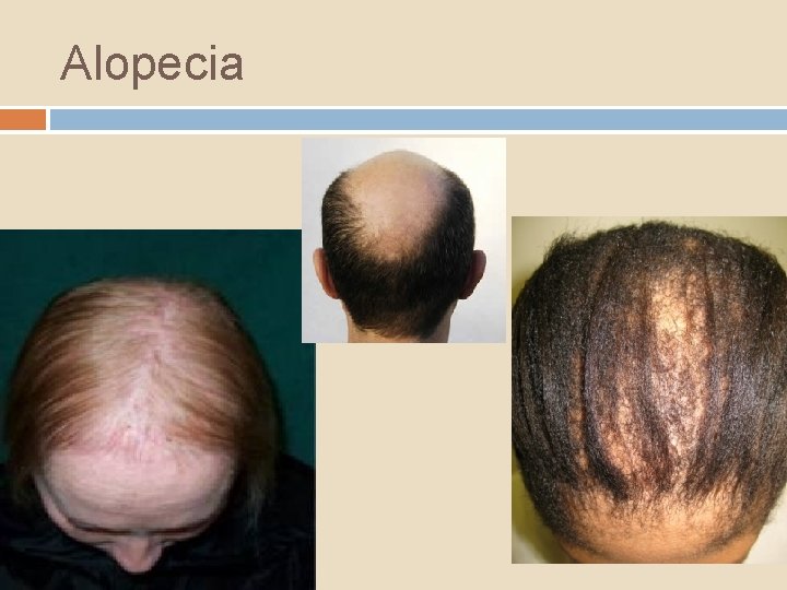 Alopecia 