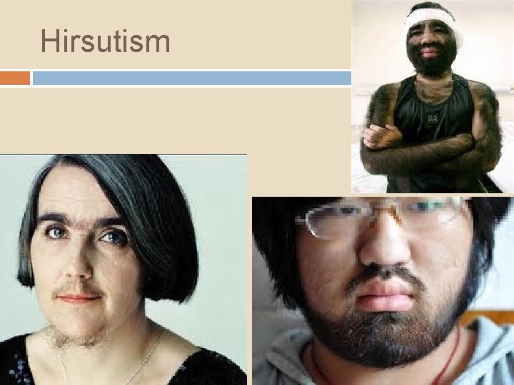 Hirsutism 