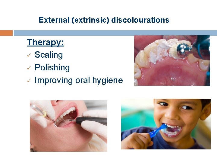 External (extrinsic) discolourations Therapy: ü Scaling ü Polishing ü Improving oral hygiene 