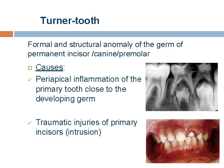 Turner-tooth Formal and structural anomaly of the germ of permanent incisor /canine/premolar ü ü