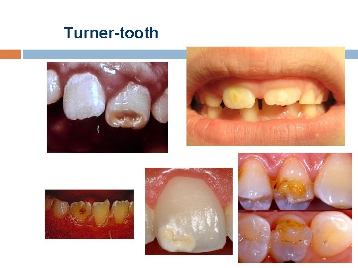 Turner-tooth 