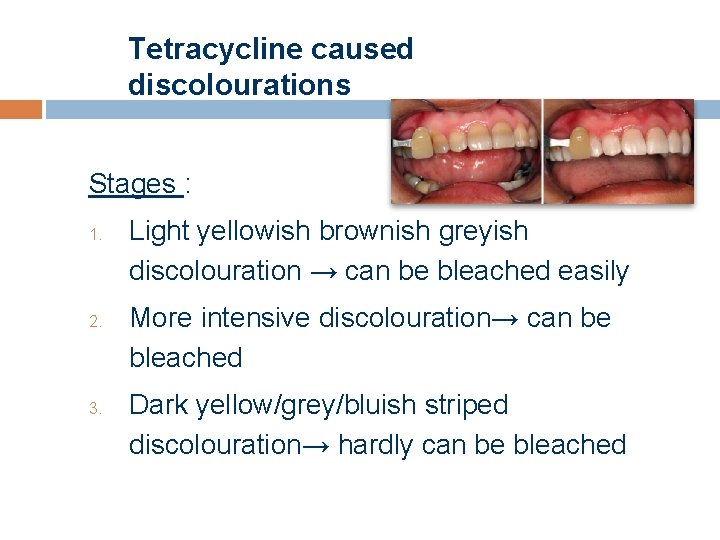 Tetracycline caused discolourations Stages : 1. 2. 3. Light yellowish brownish greyish discolouration →