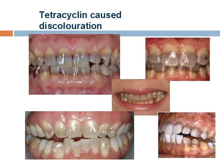 Tetracyclin caused discolouration 
