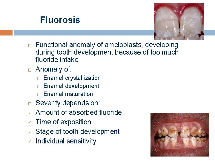 Fluorosis Functional anomaly of ameloblasts, developing during tooth development because of too much fluoride