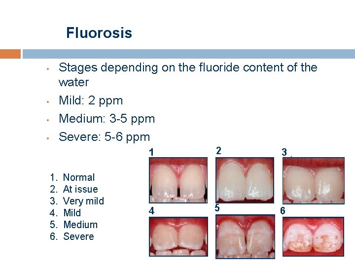 Fluorosis Stages depending on the fluoride content of the water Mild: 2 ppm Medium: