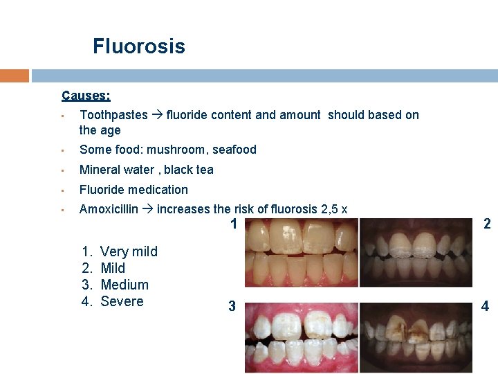 Fluorosis Causes: • Toothpastes fluoride content and amount should based on the age •