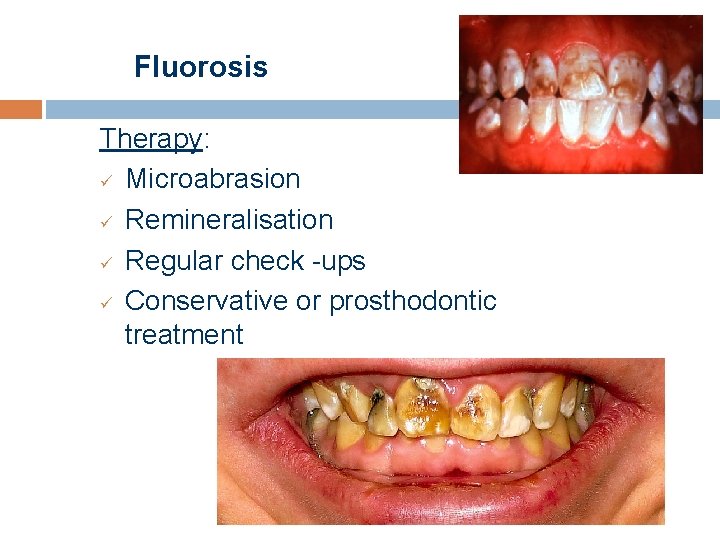 Fluorosis Therapy: ü Microabrasion ü Remineralisation ü Regular check -ups ü Conservative or prosthodontic