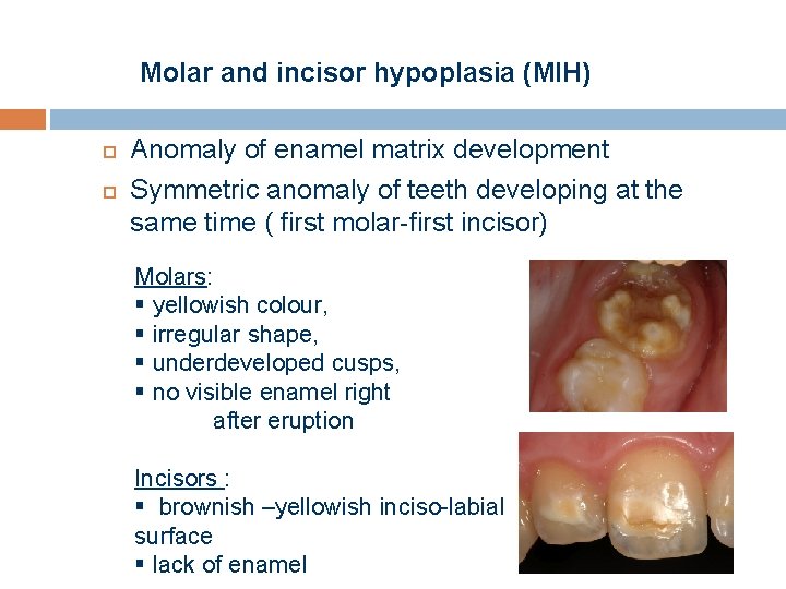 Molar and incisor hypoplasia (MIH) Anomaly of enamel matrix development Symmetric anomaly of teeth