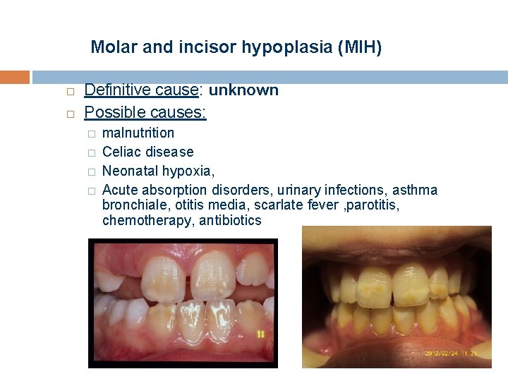 Molar and incisor hypoplasia (MIH) Definitive cause: unknown Possible causes: � � malnutrition Celiac