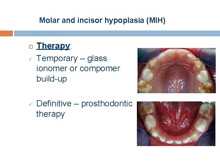 Molar and incisor hypoplasia (MIH) ü ü Therapy: Temporary – glass ionomer or compomer