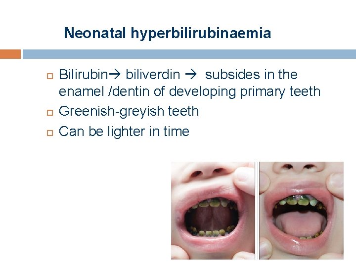 Neonatal hyperbilirubinaemia Bilirubin biliverdin subsides in the enamel /dentin of developing primary teeth Greenish-greyish