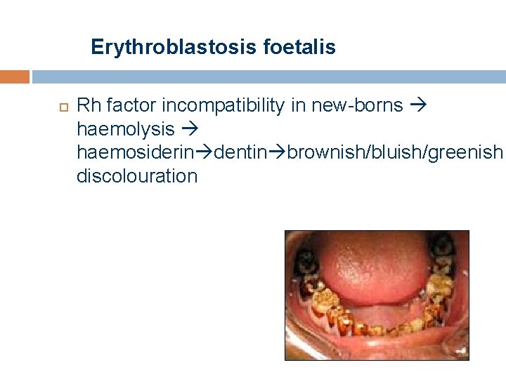 Erythroblastosis foetalis Rh factor incompatibility in new-borns haemolysis haemosiderin dentin brownish/bluish/greenish discolouration 