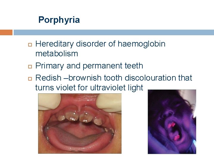 Porphyria Hereditary disorder of haemoglobin metabolism Primary and permanent teeth Redish –brownish tooth discolouration