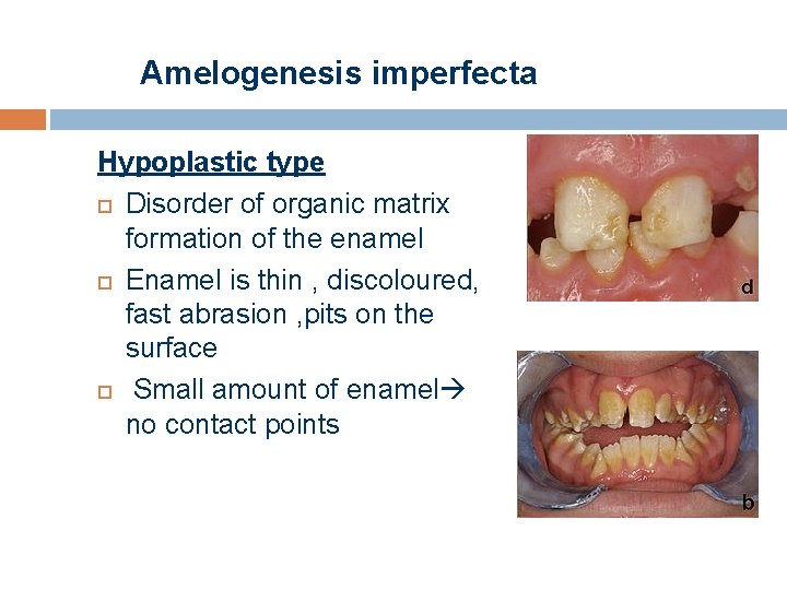 Amelogenesis imperfecta Hypoplastic type Disorder of organic matrix formation of the enamel Enamel is