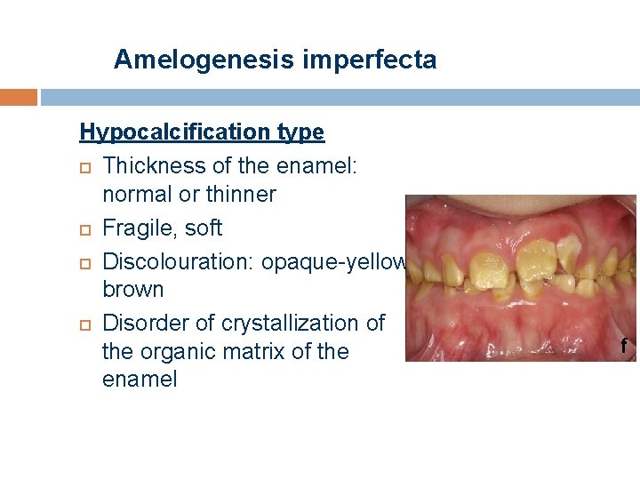 Amelogenesis imperfecta Hypocalcification type Thickness of the enamel: normal or thinner Fragile, soft Discolouration:
