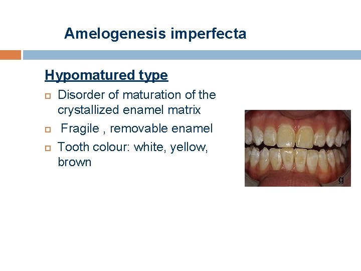 Amelogenesis imperfecta Hypomatured type Disorder of maturation of the crystallized enamel matrix Fragile ,