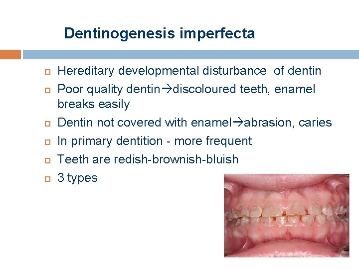 Dentinogenesis imperfecta Hereditary developmental disturbance of dentin Poor quality dentin discoloured teeth, enamel breaks