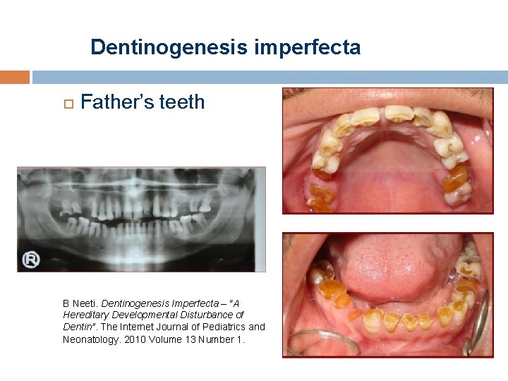 Dentinogenesis imperfecta Father’s teeth B Neeti. Dentinogenesis Imperfecta – “A Hereditary Developmental Disturbance of