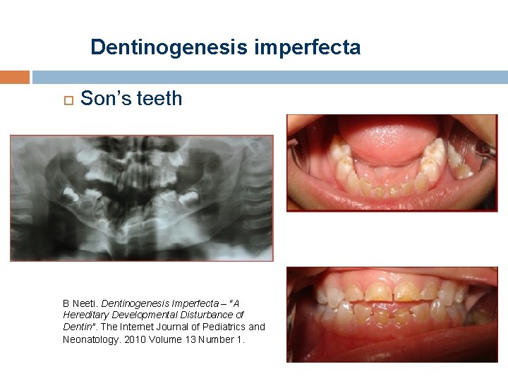 Dentinogenesis imperfecta Son’s teeth B Neeti. Dentinogenesis Imperfecta – “A Hereditary Developmental Disturbance of