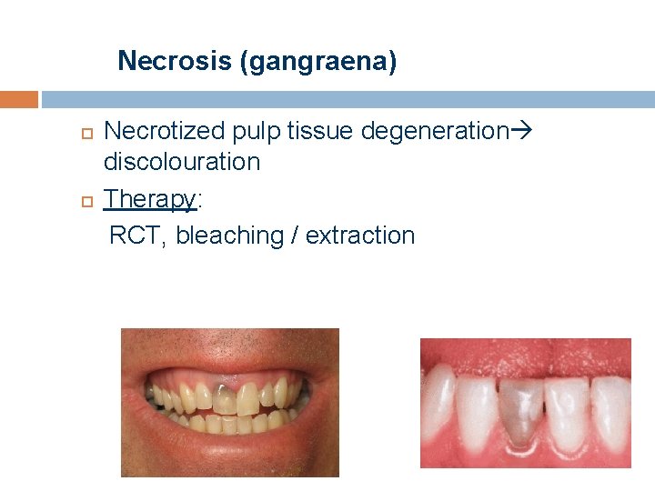 Necrosis (gangraena) Necrotized pulp tissue degeneration discolouration Therapy: RCT, bleaching / extraction 