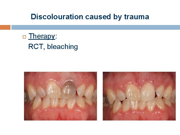 Discolouration caused by trauma Therapy: RCT, bleaching 