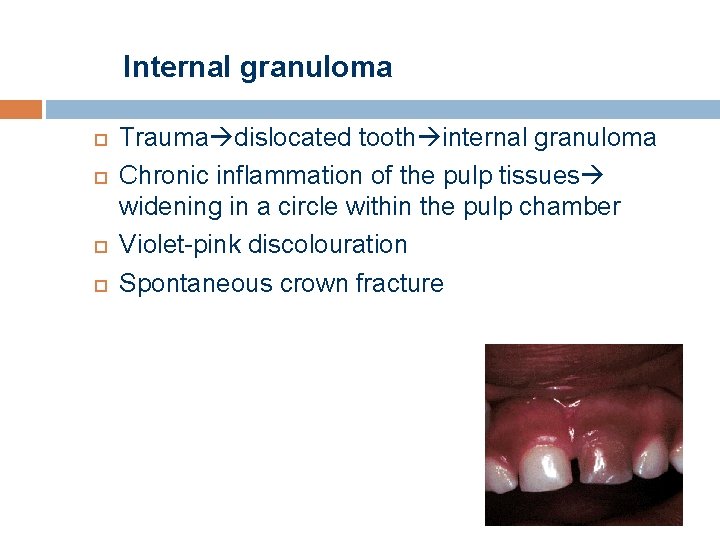 Internal granuloma Trauma dislocated tooth internal granuloma Chronic inflammation of the pulp tissues widening