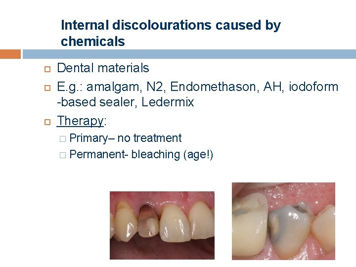 Internal discolourations caused by chemicals Dental materials E. g. : amalgam, N 2, Endomethason,